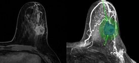 MRI vs TumorSight views